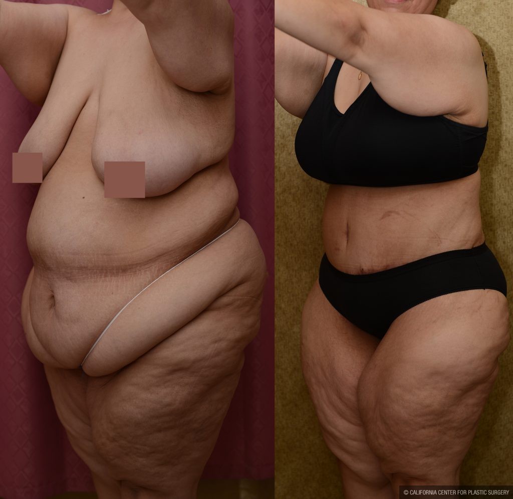 Tummy Tuck (Abdominoplasty) Plus Size Before & After Patient #11070