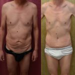 Tummy Tuck (Abdominoplasty) Small Size Before & After Patient #11075