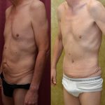 Tummy Tuck (Abdominoplasty) Small Size Before & After Patient #11075