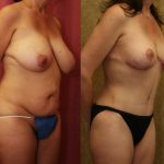 Tummy Tuck (Abdominoplasty) Small Size Before & After Patient #11079