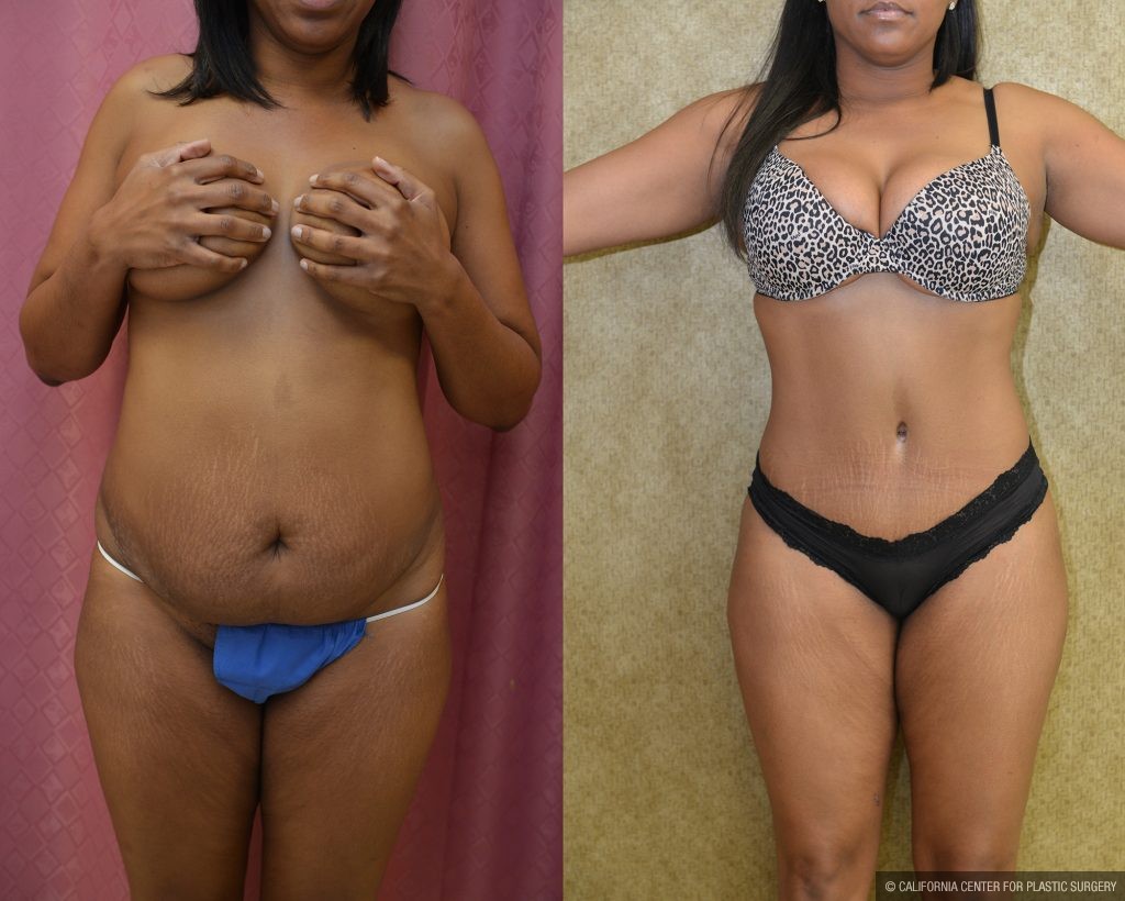 Tummy Tuck (Abdominoplasty) Medium Size Before & After Patient #11092