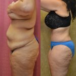 Tummy Tuck (Abdominoplasty) Plus Size Before & After Patient #11065