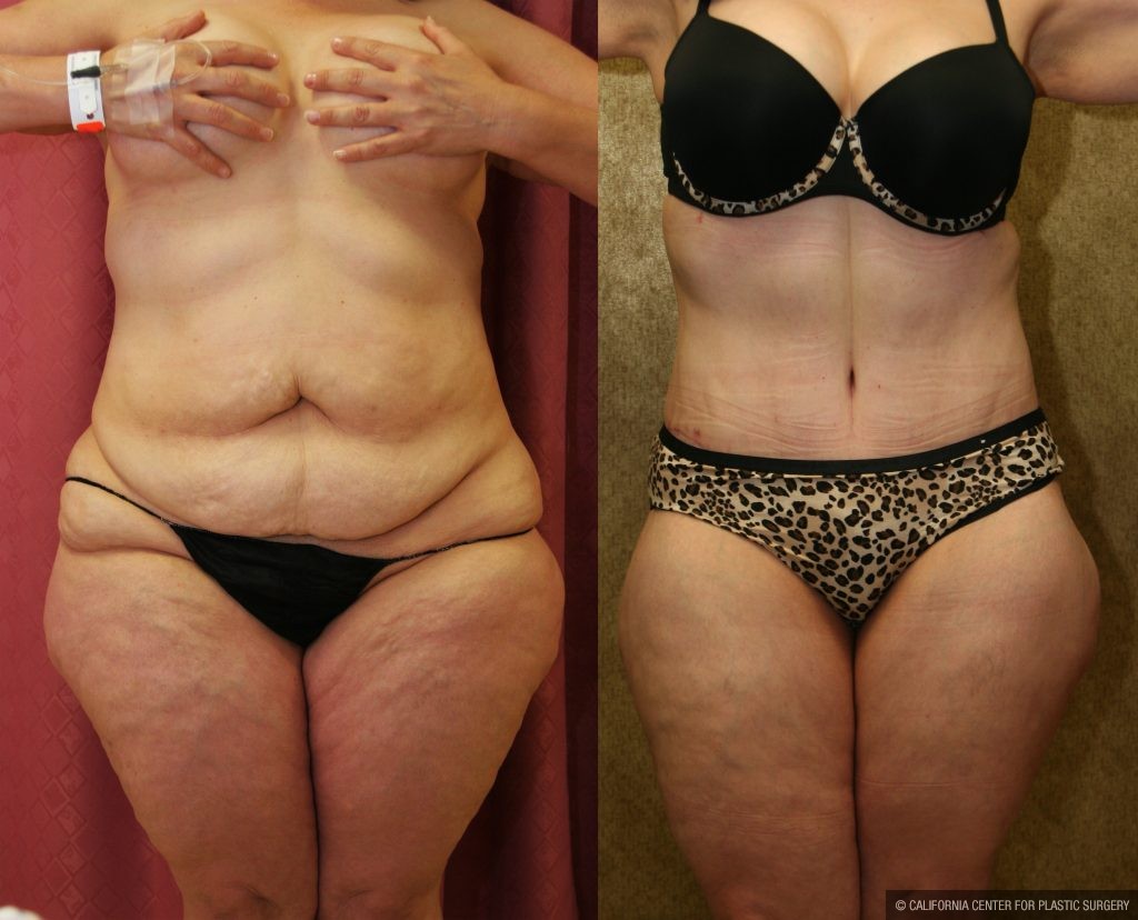 Tummy Tuck (Abdominoplasty) Plus Size Before & After Patient #11029