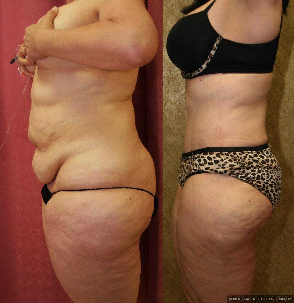 Tummy Tuck (Abdominoplasty) Plus Size Before & After Patient #11029