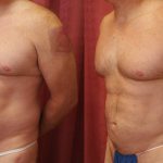 Male gynecomastia (breast) reduction Before & After Patient #10958