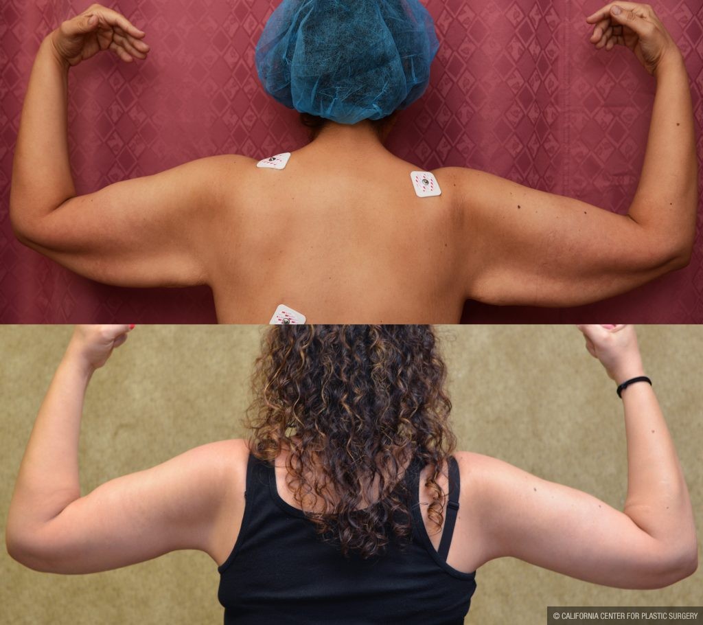 Arm Lift (Brachioplasty) Before & After Patient #10840