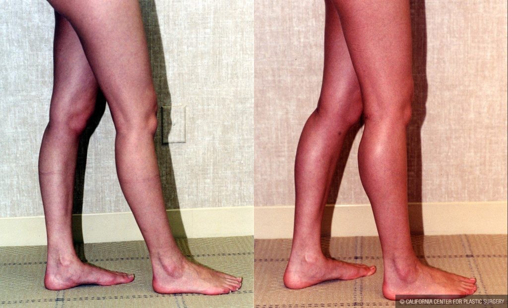 Calf Augmentation Before & After Patient #10916