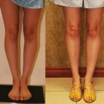 Calf Augmentation Before & After Patient #10855