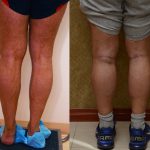 Calf Augmentation Before & After Patient #10860