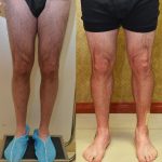 Calf Augmentation Before & After Patient #10873