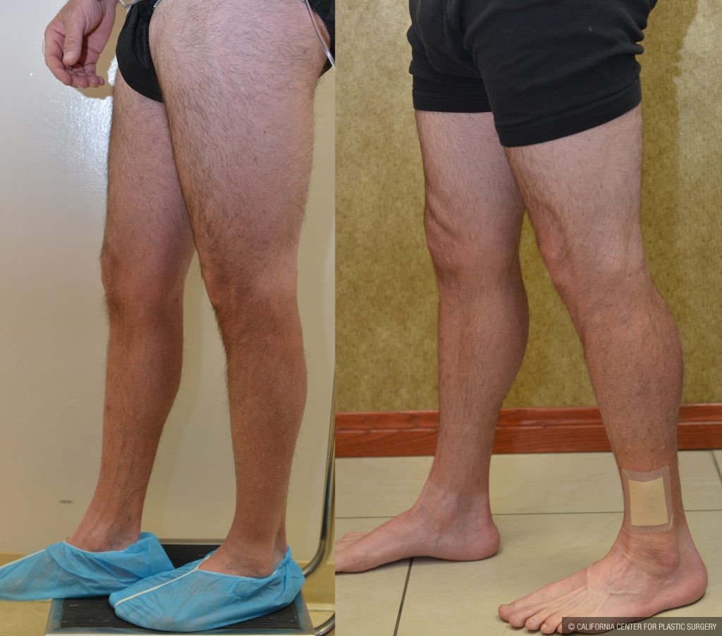 Calf Augmentation Before & After Patient #10873