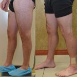 Calf Augmentation Before & After Patient #10873