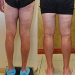 Calf Augmentation Before & After Patient #10873
