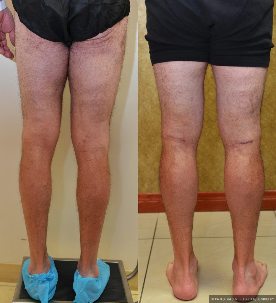 Calf Augmentation Before & After Patient #10873