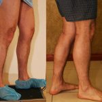 Calf Augmentation Before & After Patient #10877