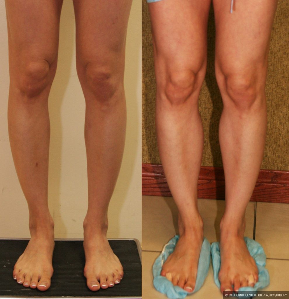 Calf Augmentation Before & After Patient #10888