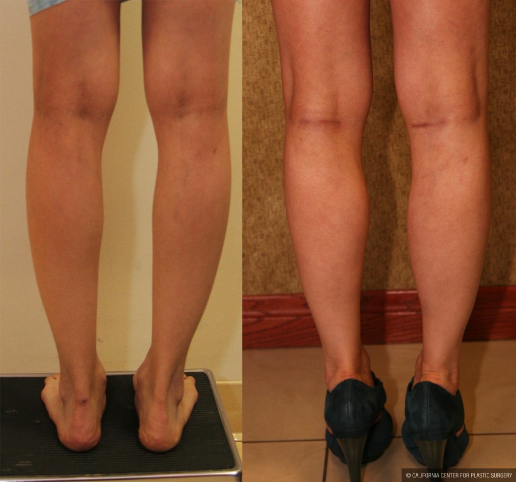 Calf Augmentation Before & After Patient #10888