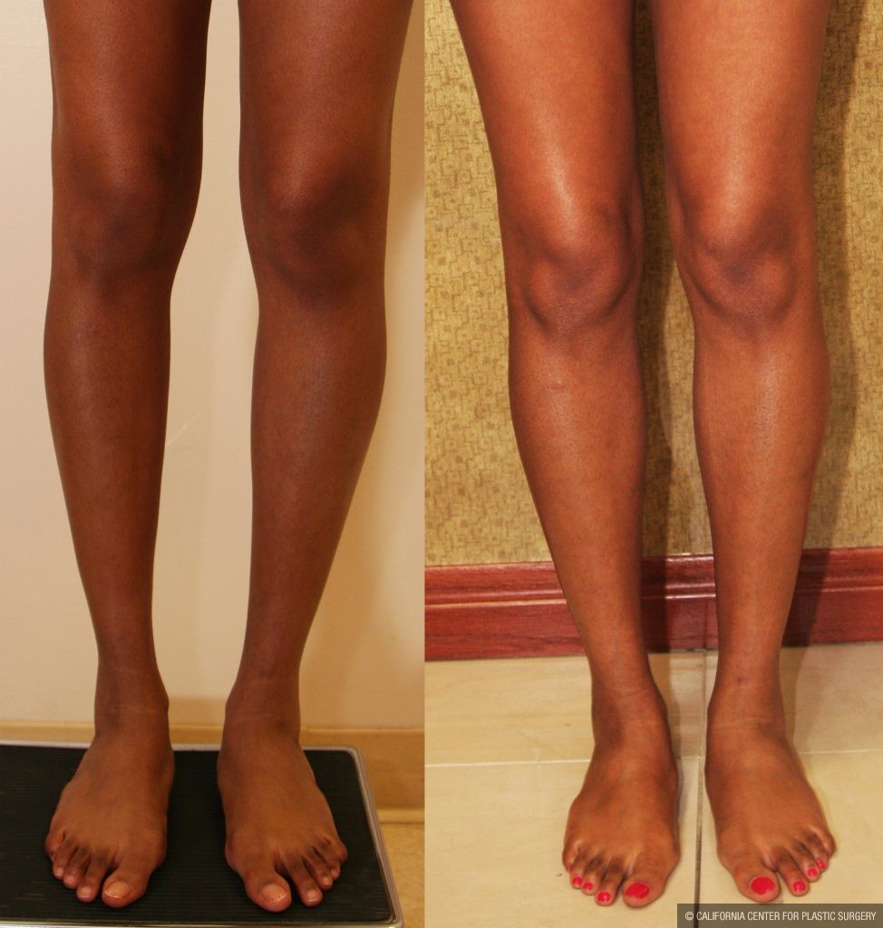 Calf Augmentation Before & After Patient #10893