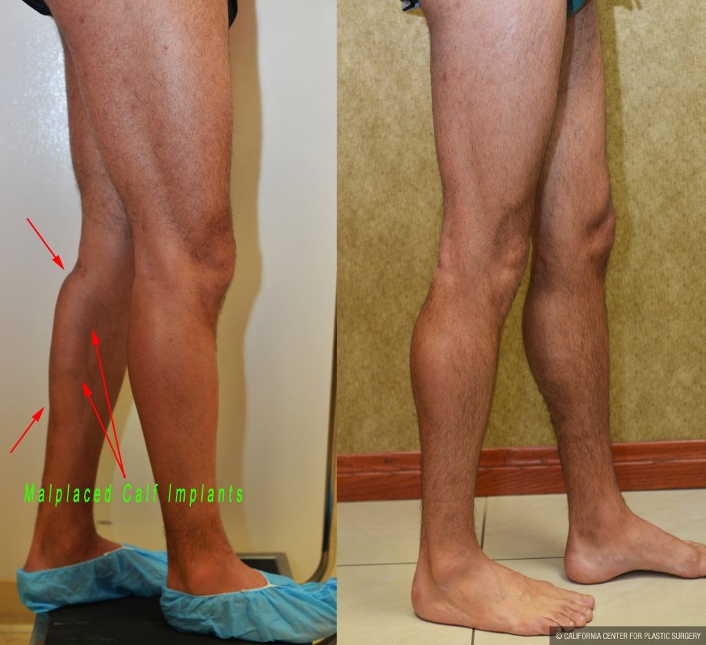 Calf Augmentation Before & After Patient #10881