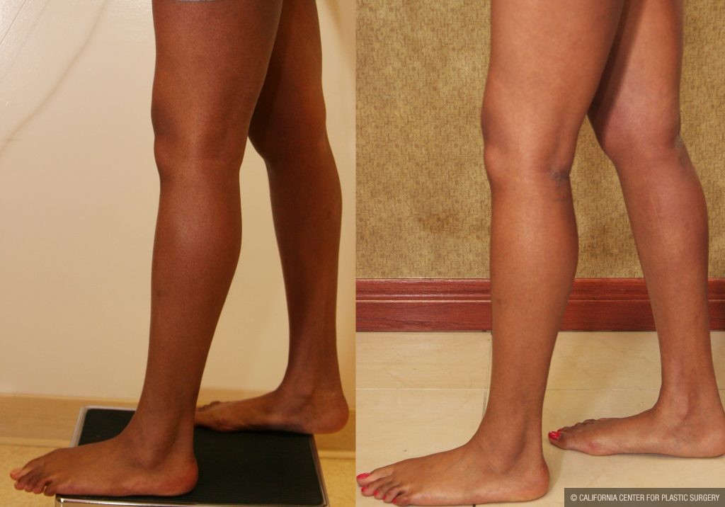 Calf Augmentation Before & After Patient #10893