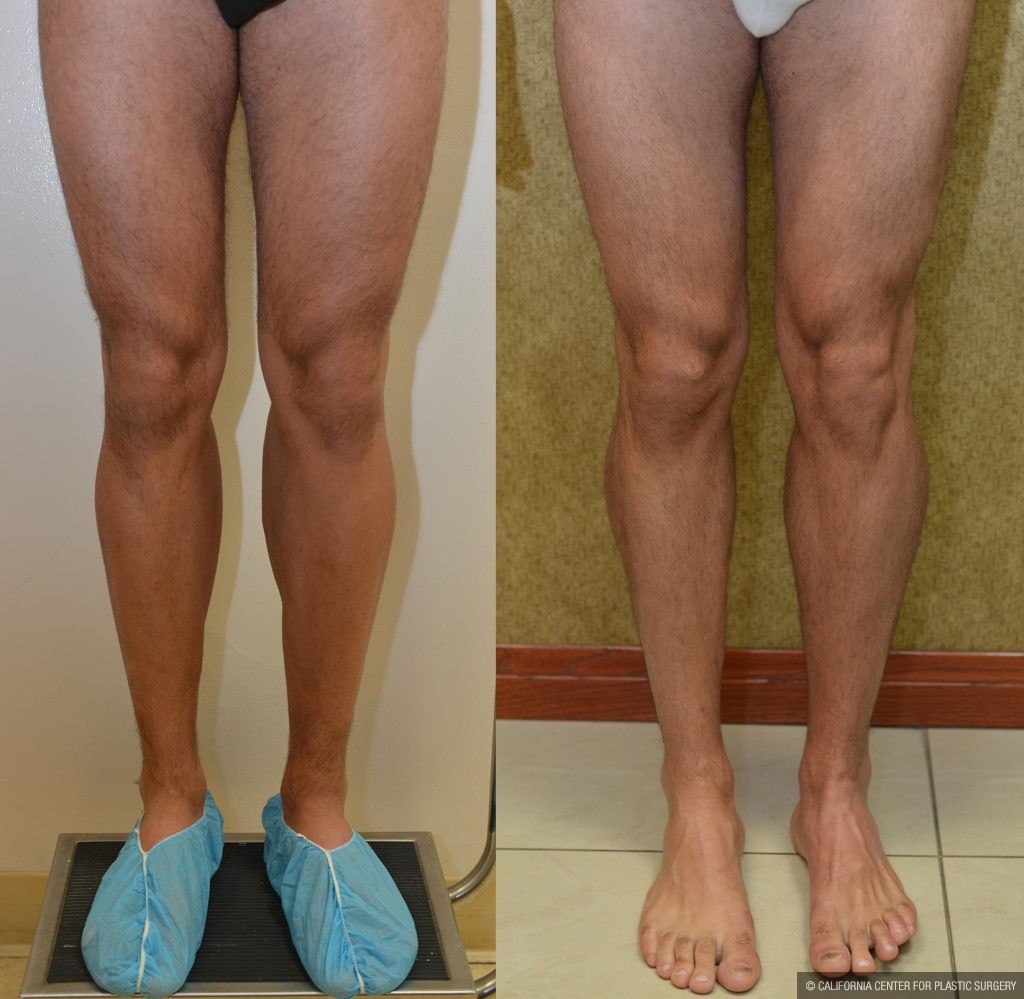 Calf Augmentation Before & After Patient #10881