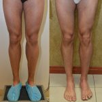 Calf Augmentation Before & After Patient #10881