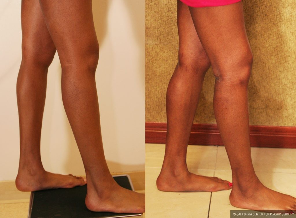 Calf Augmentation Before & After Patient #10893