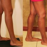 Calf Augmentation Before & After Patient #10893