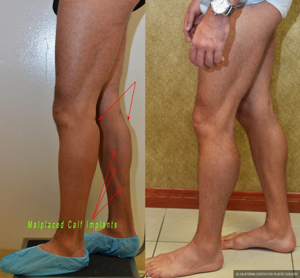 Calf Augmentation Before & After Patient #10881