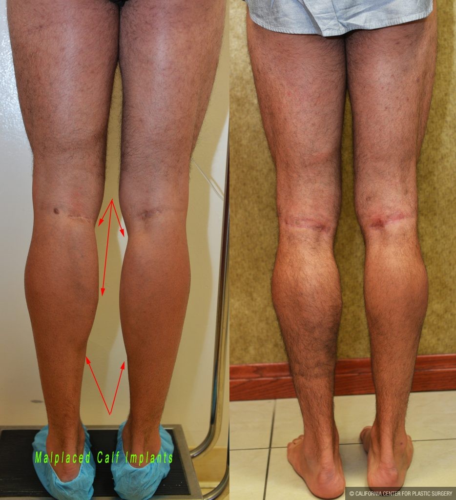 Calf Augmentation Before & After Patient #10881