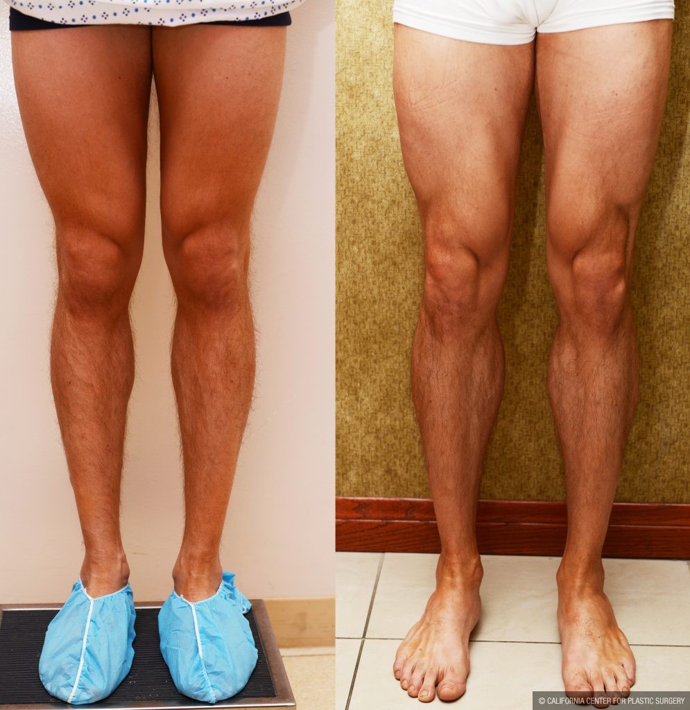 Calf Augmentation Before & After Patient #10901