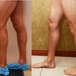 Calf Augmentation Before & After Patient #10901