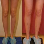 Calf Augmentation Before & After Patient #10851