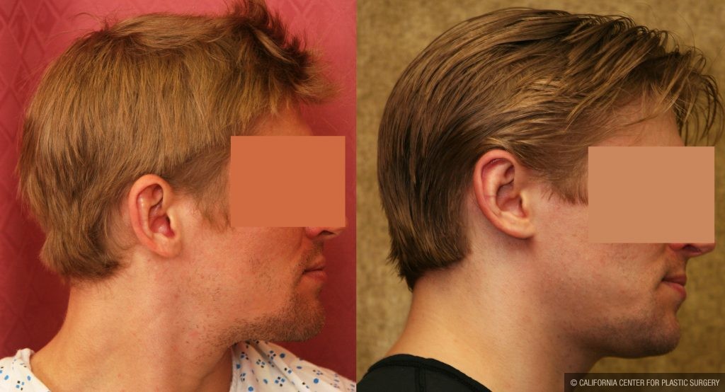 Ear (Otoplasty) Before & After Patient #10922
