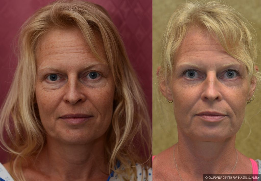 Eyelid (Blepharoplasty) Before & After Patient #10926