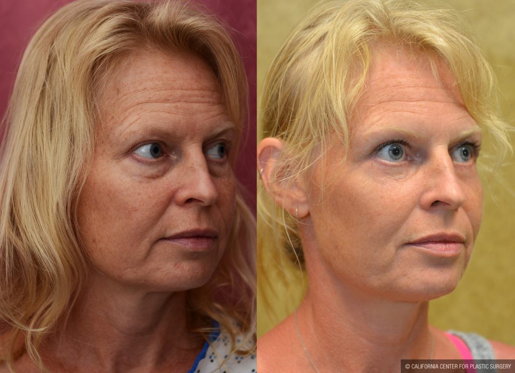 Eyelid (Blepharoplasty) Before & After Patient #10926
