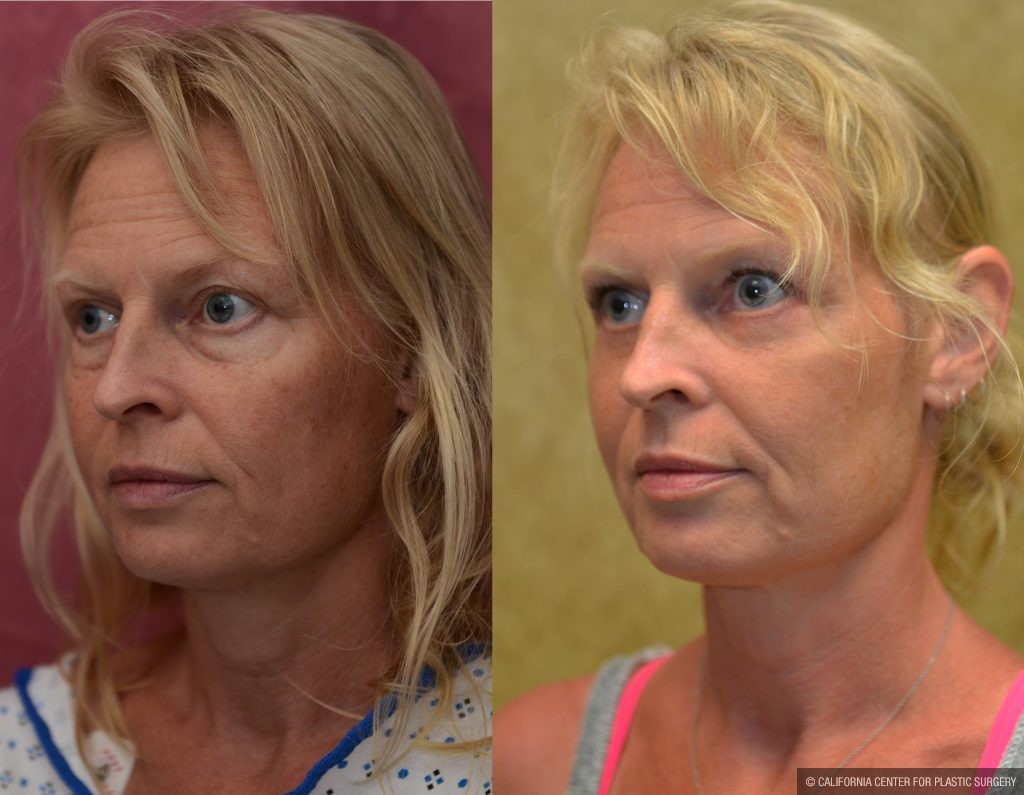 Eyelid (Blepharoplasty) Before & After Patient #10926