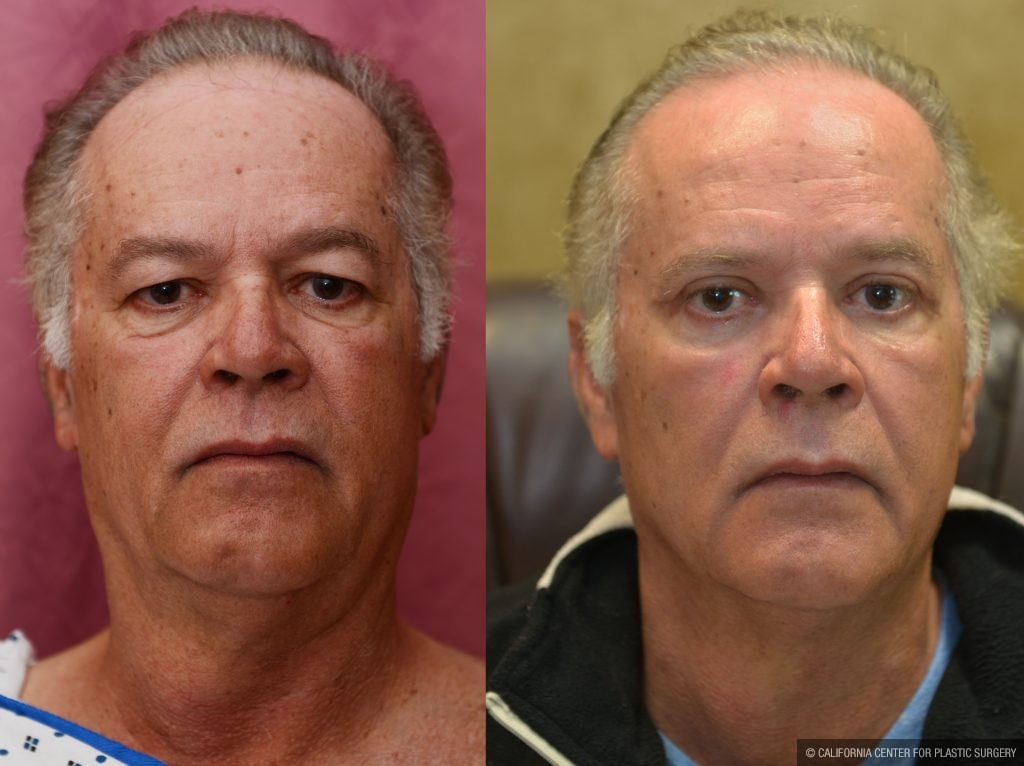 Eyelid (Blepharoplasty) Before & After Patient #10936