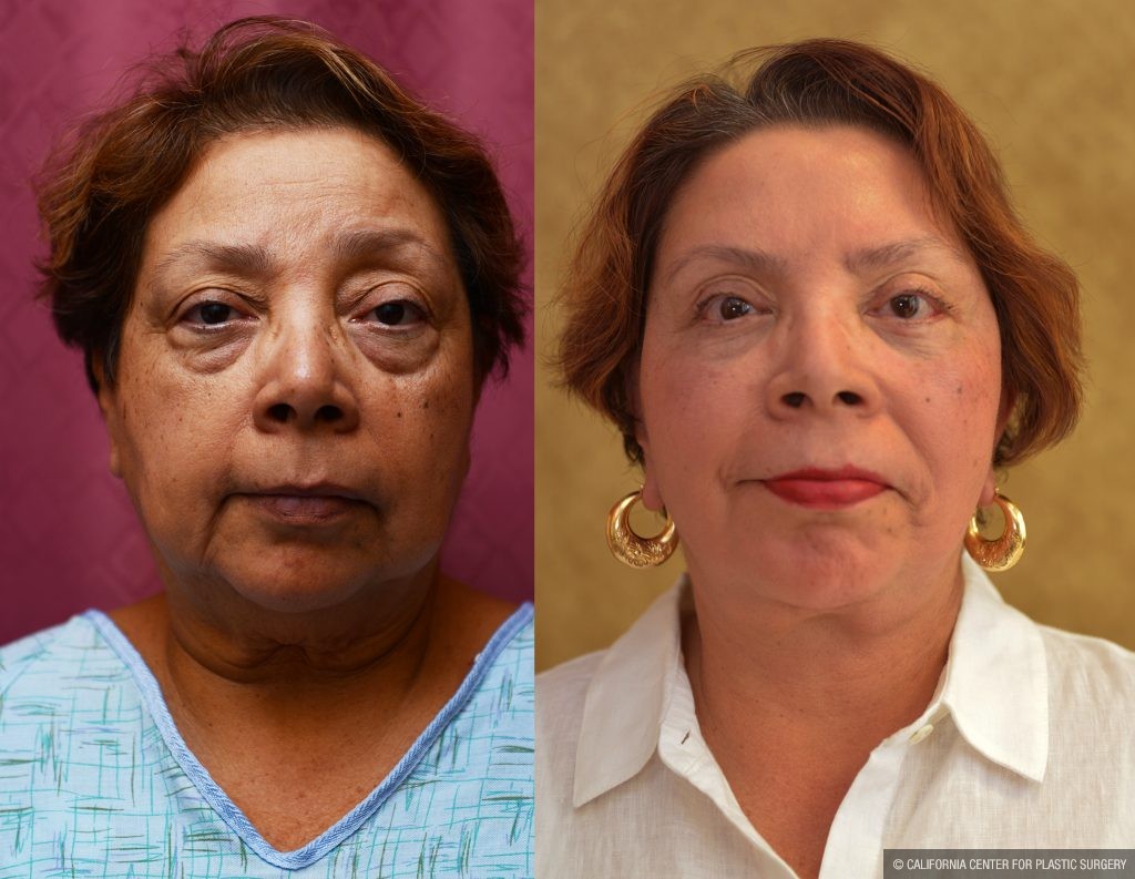 Eyelid (Blepharoplasty) Before & After Patient #10931