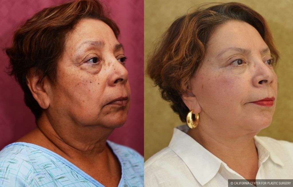 Eyelid (Blepharoplasty) Before & After Patient #10931