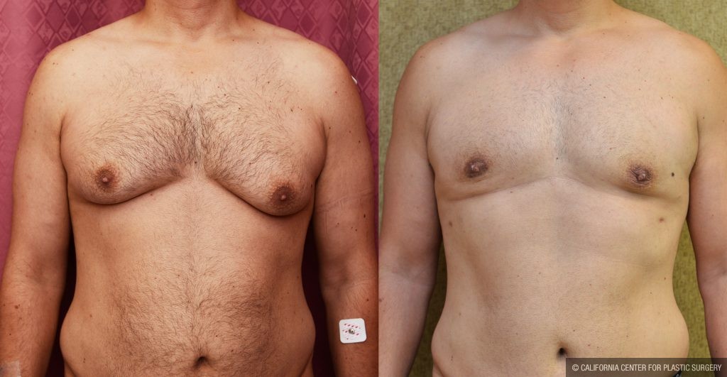 Male gynecomastia (breast) reduction Before & After Patient #10949