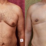 Male gynecomastia (breast) reduction Before & After Patient #10949