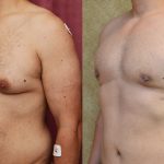 Male gynecomastia (breast) reduction Before & After Patient #10949