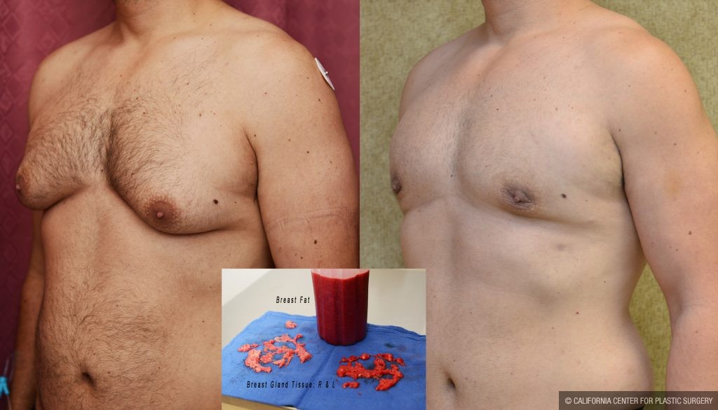 Male gynecomastia (breast) reduction Before & After Patient #10949