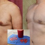 Male gynecomastia (breast) reduction Before & After Patient #10949