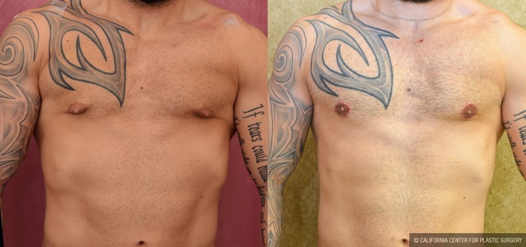 Male gynecomastia (breast) reduction Before & After Patient #10944