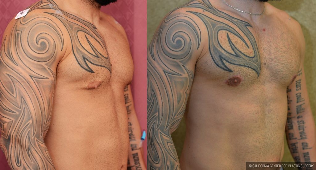 Male gynecomastia (breast) reduction Before & After Patient #10944