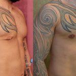 Male gynecomastia (breast) reduction Before & After Patient #10944