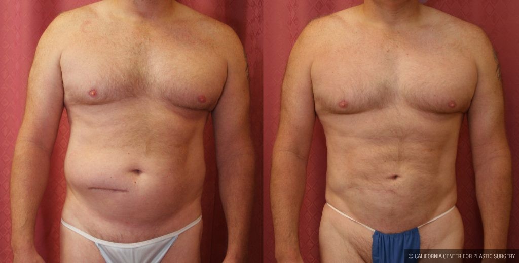 Male gynecomastia (breast) reduction Before & After Patient #10958