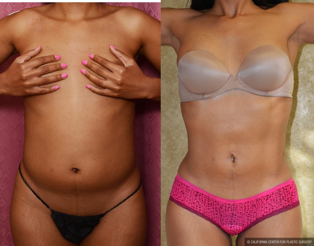 Liposuction Abdomen Medium Before & After Patient #10961